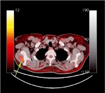 Şekil 3. Sağ piriformis ve rektus abdominis kasları içerisindeki hipermetabolik  odakları gösteren PET/BT füzyon görüntüsü.