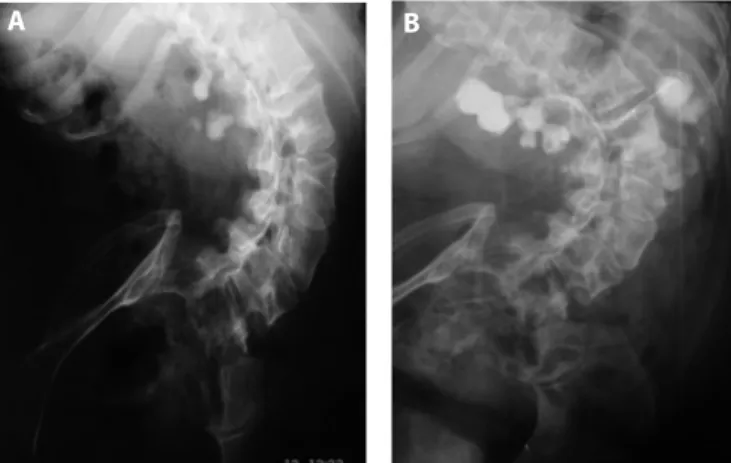 Şekil 1. Konkav tarafında alt pol taşları olan ve konveks tarafında üreteropelvik  bileşke taşı olan 42 yaşında kifoskolyotik hastanın preoperatif IVP’si.