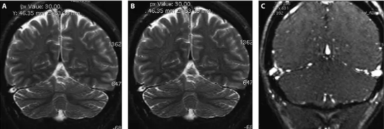 Şekil 2 (A). 45 yaşında kadın hastadaT2 ağırlıklı koronal imajda sağ transvers sinüste araknoid granülasyon ve ortasında ‘nokta işareti’ izlenmektedir