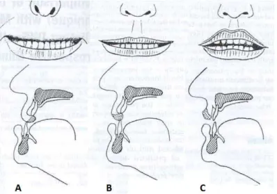 Şekil 2: Üst dudak ısırma testinin şematik görünümü (A: Sınıf 1, B: Sınıf 2, C: Sınıf 3) 