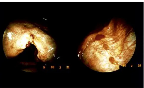 Şekil  6      Peritoneal endometriozisin laporoskopik görüntüsü. 