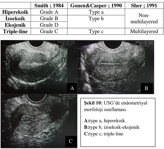 Şekil 10: USG’de endometriyal  morfoloji sınıflaması.   A:type a, hiperekoik                  B:type b, izoekoik-ekojenik  C:type c, triple-line A  B  C 