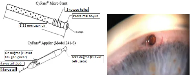 Şekil  7-8:  CyPass  Mikro-Stent  (Ansari  E,  An  Update  on  Implants  for  Minimally  Invasive  Glaucoma  Surgery  (MIGS),  Ophthalmol  Ther