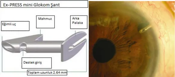 Şekil 15-16: ExPress mini implant (http://www.mdalert.com/article/longterm-data-on- (http://www.mdalert.com/article/longterm-data-on-express-shunt-for-uncontrolled-glaucoma-are-very-promising) 