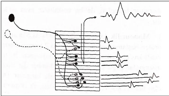 Şekil  4.  Nörojenik  kas  atrofisinde  kollateral  reinnervasyon  şeması,  polifazik,  geniş  süreli 