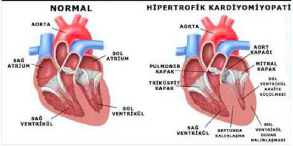 Şekil 8: Koroner arter anomalileri: CX: Sirkumfleks arter, LAD: Sol koroner arter dalı RCA:  Sağ koroner arter 