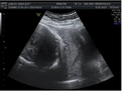 Şekil 1: Plasenta Previa Olgusunun Transabdominal Ultrasonografi Görüntüsü 