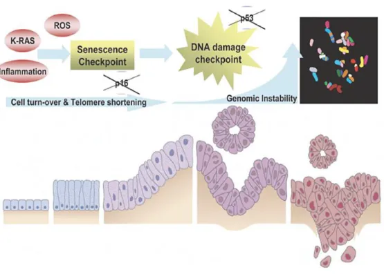 Şekil 3: Pankreas kanserine ilerleme ve genomik instabilite (30) 