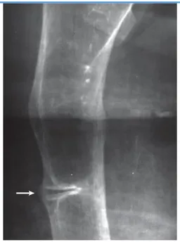Şekil 3: Erişkin hipofosfatazyada görülen  psödofraktür:57 yaşında kadın hastanın  osteopenik  sağ  femur  ve  karakteristik  psödofraktür