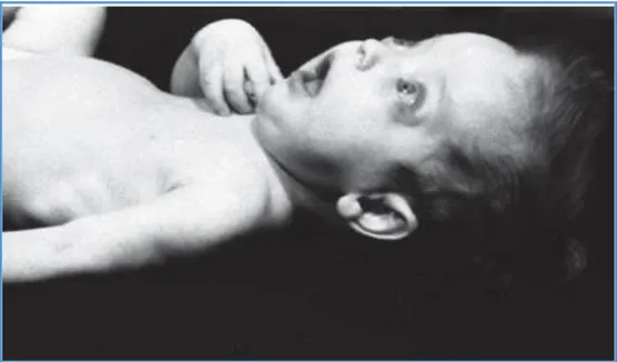 Şekil  6: İnfantil Hipofosfatazyaya ait görüntü 4 aylık kız hastada kalıcı ön fontanel, 