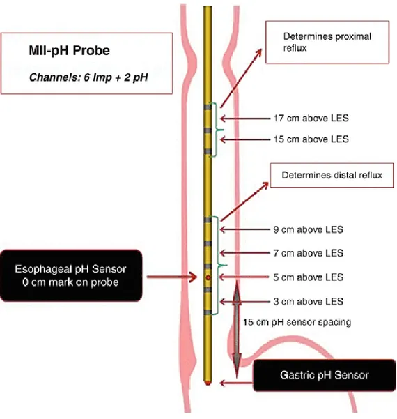 Şekil  8:  ÇKİİ-pH  kateteri  ve  özofagustaki  konumu[43]  (6  impedans  ve  2  pH  kateterinin özofagustaki yerleşimi görülmektedir