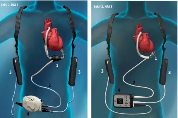 Şekil 1 ve 2:  Sırasıyla  Heart  Mate  II  ve  Heart  Mate  3  SVDC  cihazlarının  şematik  şeklini 