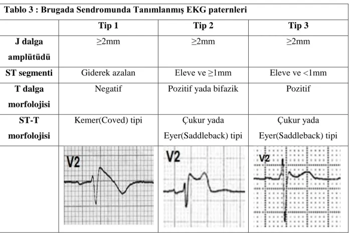 Tablo 3 : Brugada Sendromunda Tanımlanmış EKG paternleri 