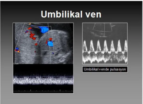 Şekil 10: Umblikal ven 