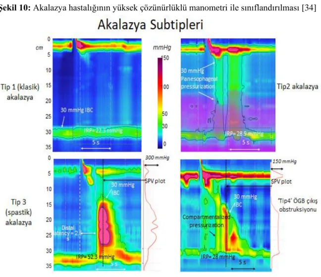 Şekil 10: Akalazya hastalığının yüksek çözünürlüklü manometri ile sınıflandırılması [34] 