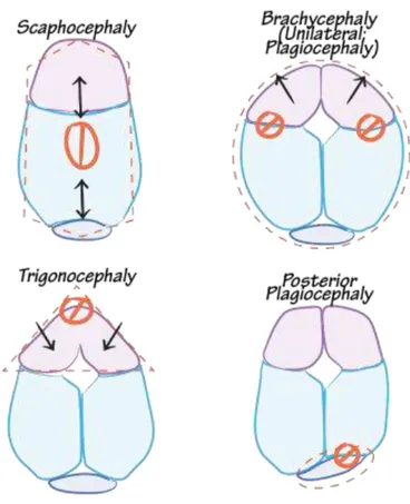 Şekil 3: Kraniosinostozda Oluşan Kafa Şekilleri 