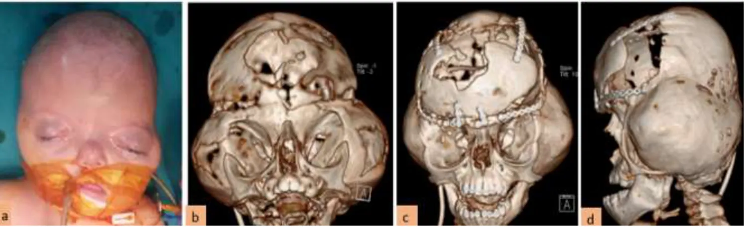 Şekil 6 : Aynı anomaliye sahip başka bir hastanın preop ve postop 3D kranial görüntüleri 