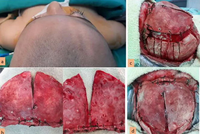 Şekil 9:  Bilateral Frontoorbital İlerletme Ve Frontal Yeniden Şekillendirme 