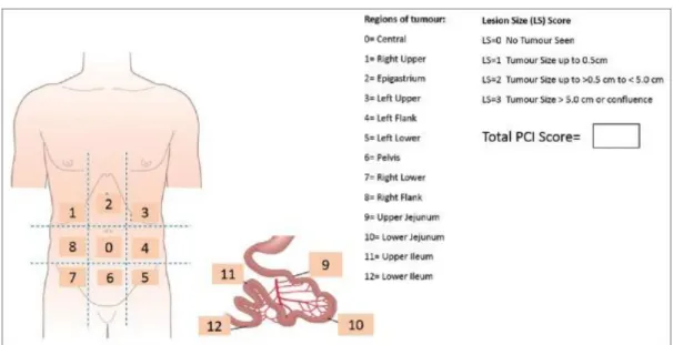 Şekil 1.Peritoneal Karsinomatozis Index 