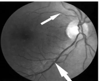 Şekil 2: Hipertansif retinopatili bir olguda fundoskopik görüntüleme; Salus işareti 