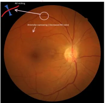 Şekil  4:  Hipertansif  retinopatili  (Evre  2)  bir  olgunun  fundoskopik  bakısında  arteriyoler incelme ve AV nicking’i gösteren bir resim (kaynak : www.uptodate.com) 