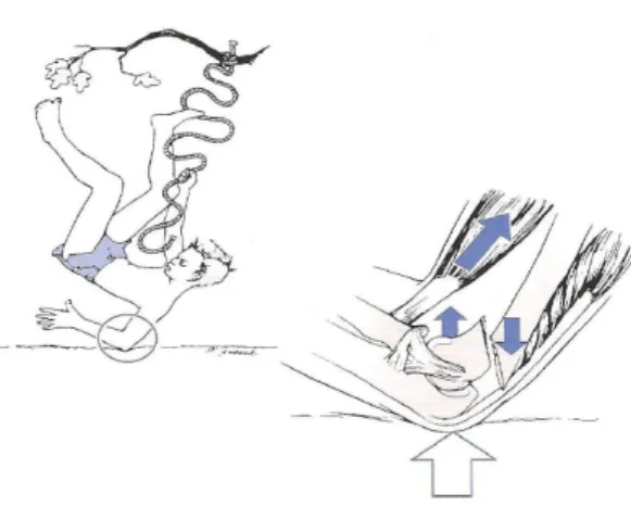 Şekil  12:  Dirseğin  direkt  travmaya  maruz  kalması  ve  distal  kırık  parçanın  anteriora  yer  değiştirdiği Fleksiyon tipi yaralanma 