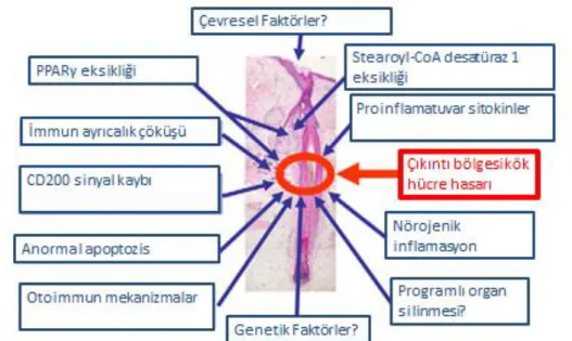 Şekil 2. PSA’da olası patogenetik faktörler (66). 