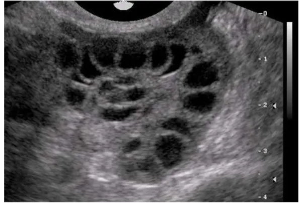 Şekil 1. Polikistik over ultrasonografi görüntüsü 
