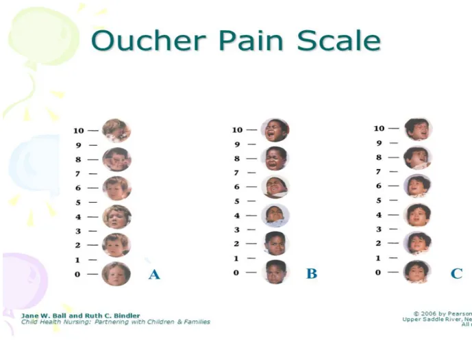 Şekil 8.Oucher skalası 