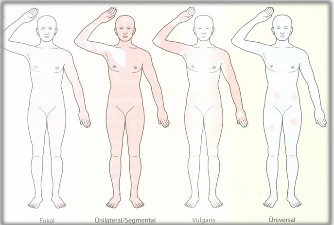 Şekil 3: Vitiligo da amelanotik deri lezyonlarının dağılımı (kaynak 11’den  alınmıştır)