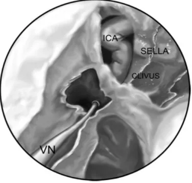 Şekil 5: Vidian sinir (VN), İnternal karotid arter (ICA) ilişkisi (12) . (Sağ taraf) 