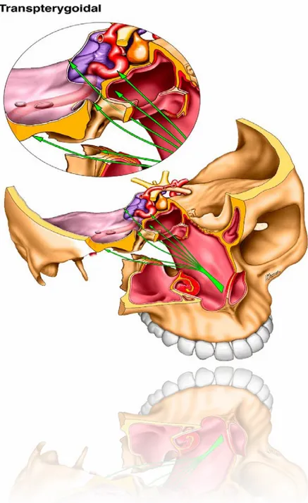 Şekil  13:  Transpterygoidal  koridor  kavernöz  sünüse,  clivusun  üst  ve  lateral  bölümlerine,  petröz  apekse  ve  infratemporal  fossaya  genellikle  tek  taraflı  olarak  ulaşımı sağlar