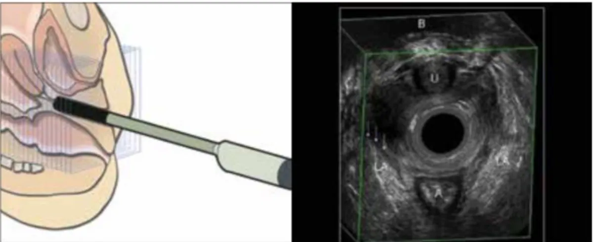 ġekil 9: Endovaginal ultrasonografi ile levator ani defektinin görüntülenmesi 