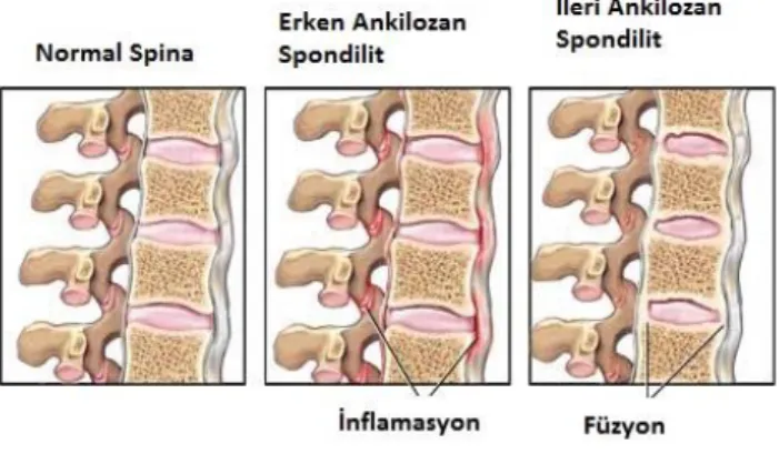 Şekil 1. AS’de spinal dejenerasyon 