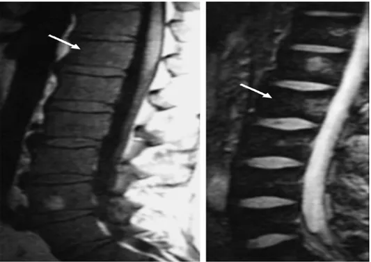 Şekil 2.3. Lomber  vertebranın  T1  ve  T2  görüntüleri,  vertebra cisimlerinde osteoskleroz  değişikliklerini temsil eden kemik iliğinde (oklar) bir azalmayı ortaya koymaktadır  78