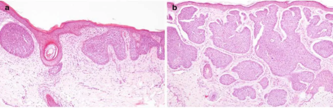 Şekil 6:  (a) Süperfisyel bazal hücreli karsinomda epidermise bağlı tümör adaları, (b)  Nodüler bazal hücreli karsinomda dermiste yerleşen nodüler tümör adaları.