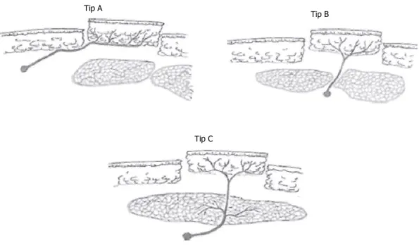 Şekil 5: Septokutan flepler (Mathes SJ, Nahai F: Classification of the vascular  anatomy of the muscles: experimental and clinical correlation
