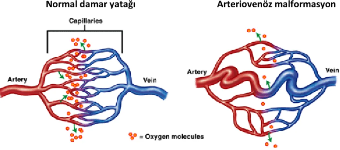 Şekil 2.1.Normal damar yatağı, Arteriovenöz malformasyonlu damar yapısı ve damar duvarı 