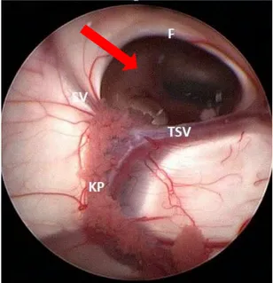 Şekil 1: Sağ lateral ventrikülün endoskopik görünümü. F, forniks.      ,  foramen Monro