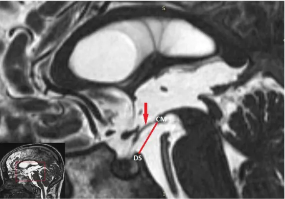 Şekil  8:  3  boyutlu  T2  ağırlıklı  CISS  sekans  beyin  MRG  üzerinde  tüber  sinerumun,  dorsum  sella  ile  korpus  mamillare  arasına  çizilen  hatta  göre  yerleşiminin  belirlenmesi