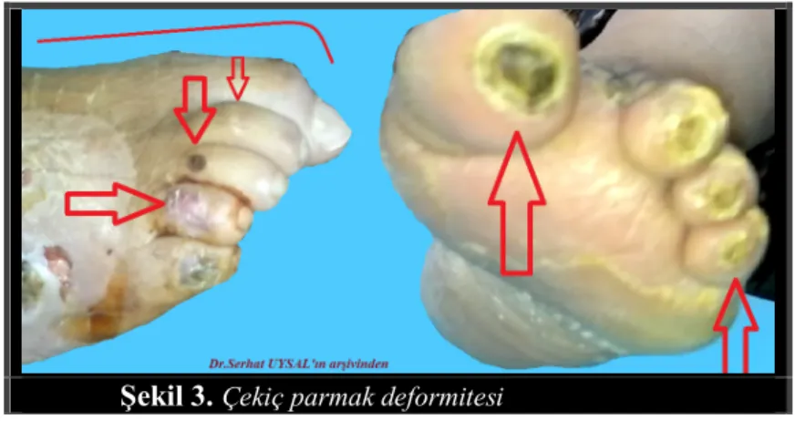 Şekil 3.  Çekiç parmak deformitesi