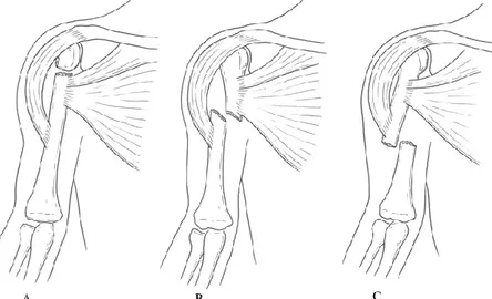 Şekil 4A-B-C: humerus diafiz kırıklarında kasların  değişik seviyelerde kırık deplasmanına etkisi 