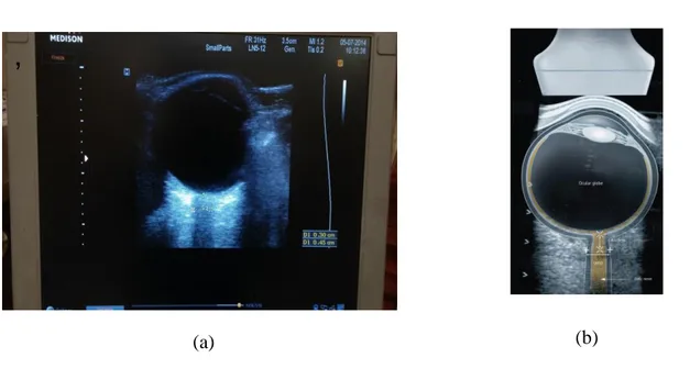 Şekil 4. (a) Optik sinir kılıf çapı ölçümünün ultrasonografi görüntüsü, (b)Optik sinir kılıf çapı  