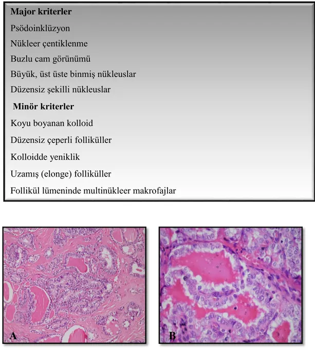 Tablo 9. Tiroidin papiller karsinomu folliküler varyant tanısında Lloyd kriterleri (79) 