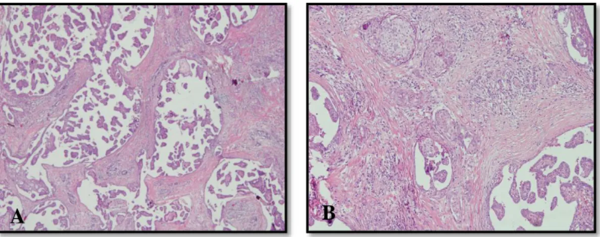 Şekil 12. A-B. Tiroidin papiller karsinomu diffüz sklerozan varyant   2.7.8.7. Yüksek silendirik hücreli varyant 