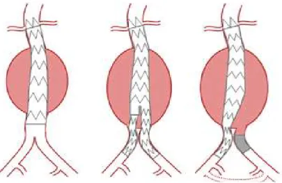 Şekil 5. Aortik stent-greft konfigürasyonları (52) 