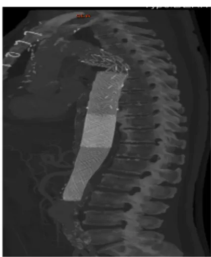 Şekil 6. Fenestre greft stentler                           Şekil 7. Multilayer stent 