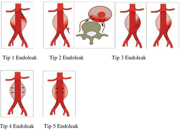 Şekil 9. Endoleak tiplerinin şematik görünümü. 