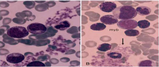 Şekil 2: KML, periferik yayma A) artmış trombosit ve granüler seri elemanlar, B) blast izlenmekte