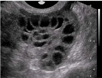 Şekil 1: Polikistik over ultrasound görüntüsü 